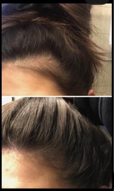 Microneedling Scalp
